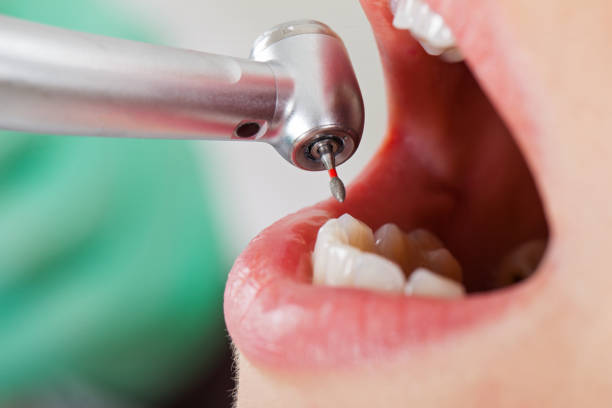 Best Emergency Wisdom Teeth Removal in Moravian Falls, NC